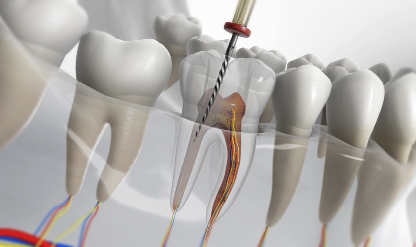 procedure of root canals