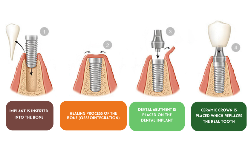 process of getting implants