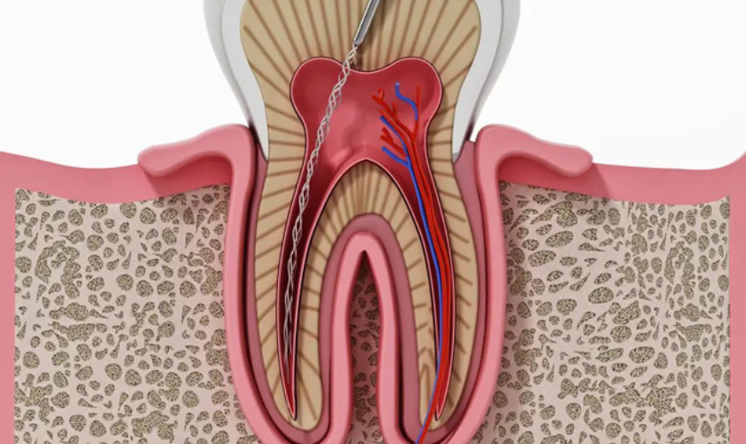 root canal therapy