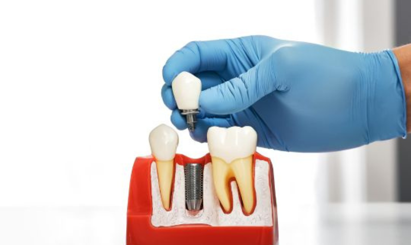unmatched benefits of dental implants