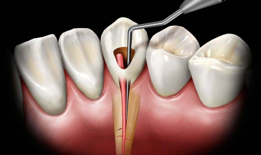 Root Canal Myth 2