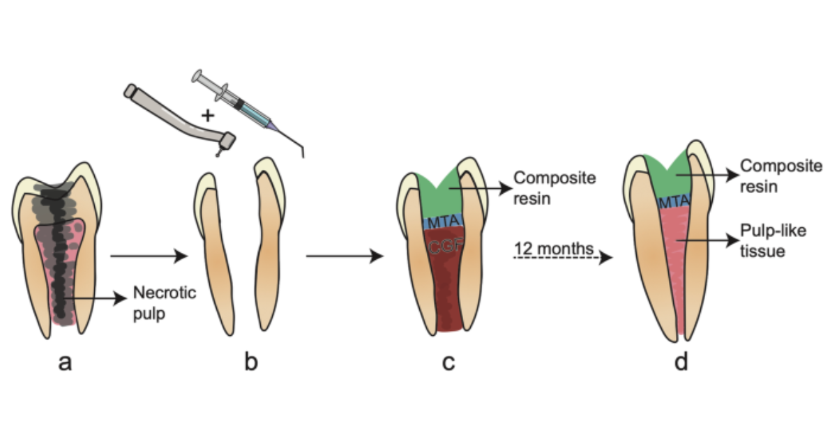 preparing for pulp regeneration
