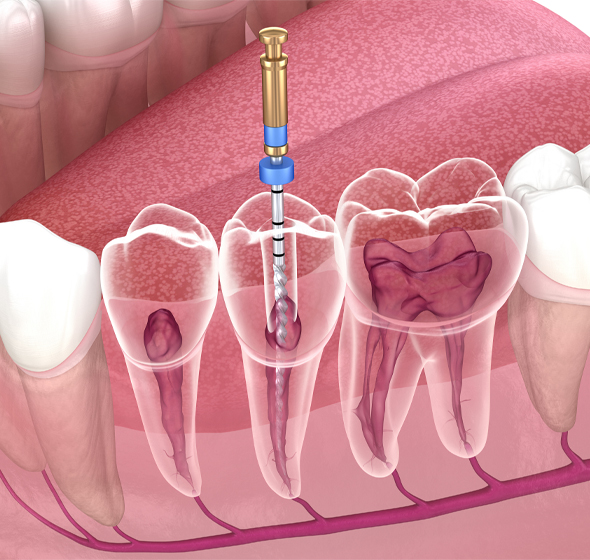 Endodontic Surgery in Waco TX