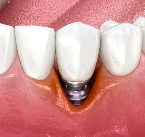 Peri-Implantitis Treatment Fort Worth