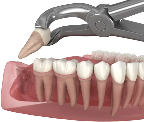  wisdom tooth extractions in Fort Worth