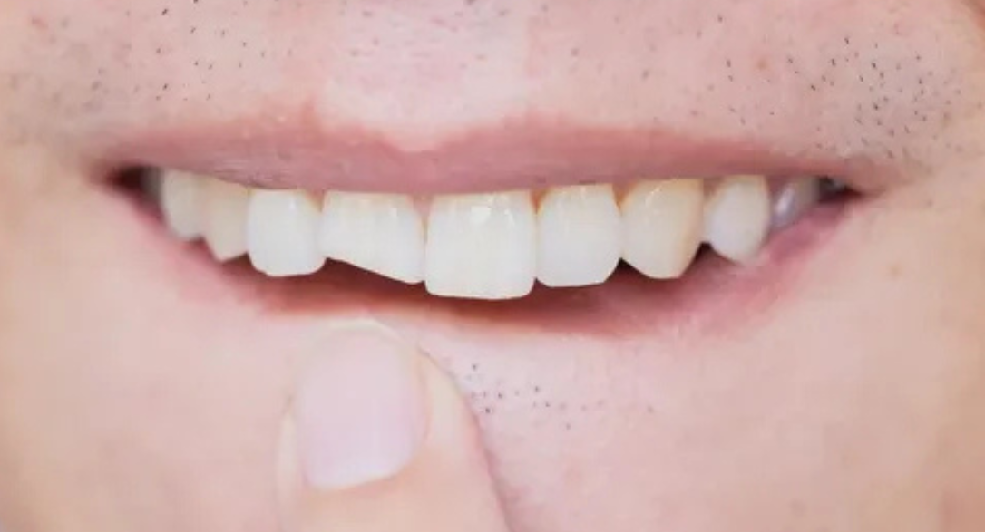 Managing a Cracked Tooth