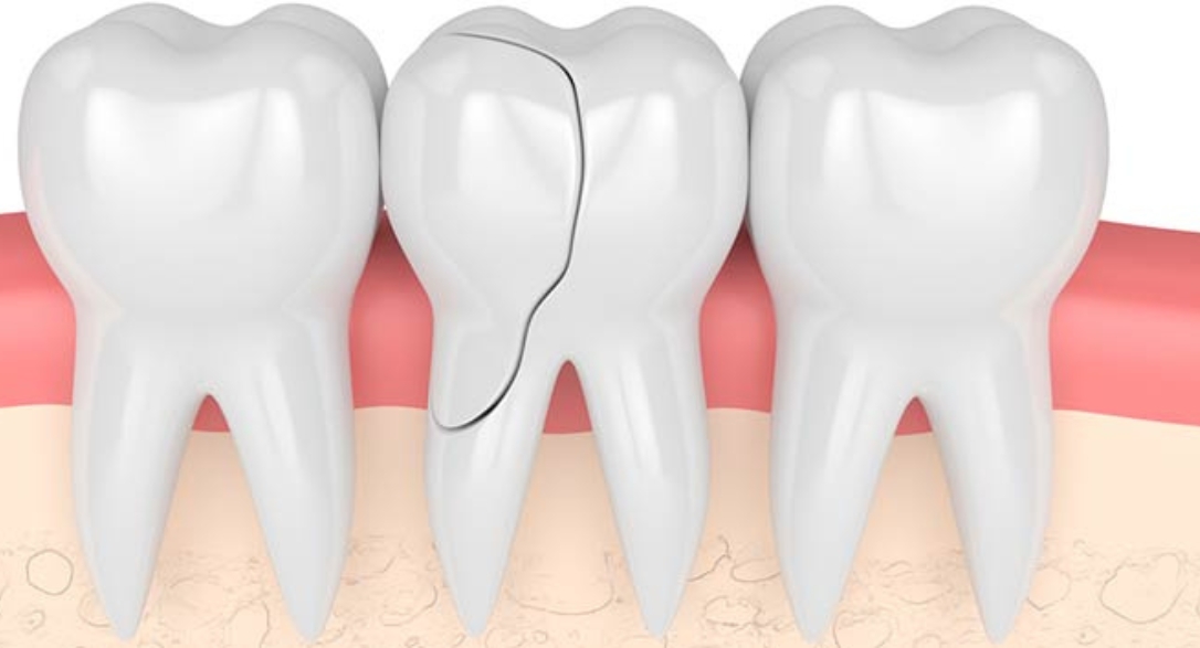 cracked teeth repair aftercare