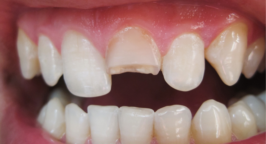 can a cracked tooth be saved