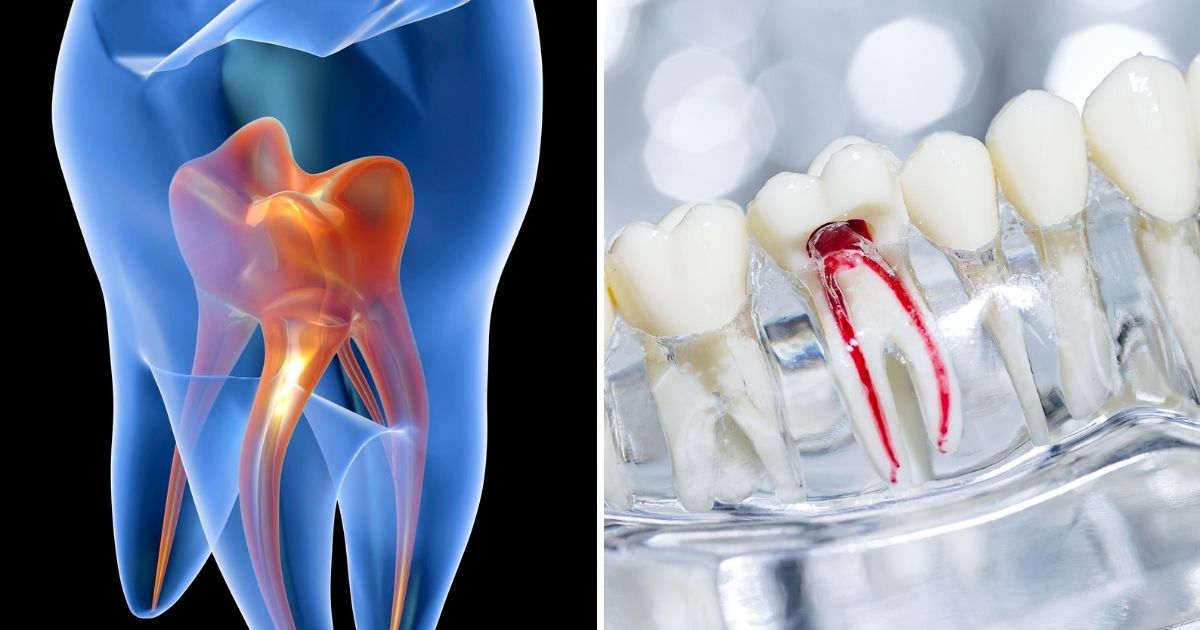 purposes of vital pulp therapy and root canal