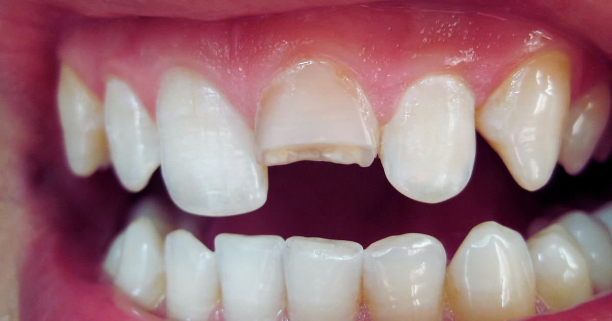 understanding cracked teeth symptoms, causes, and treatment options