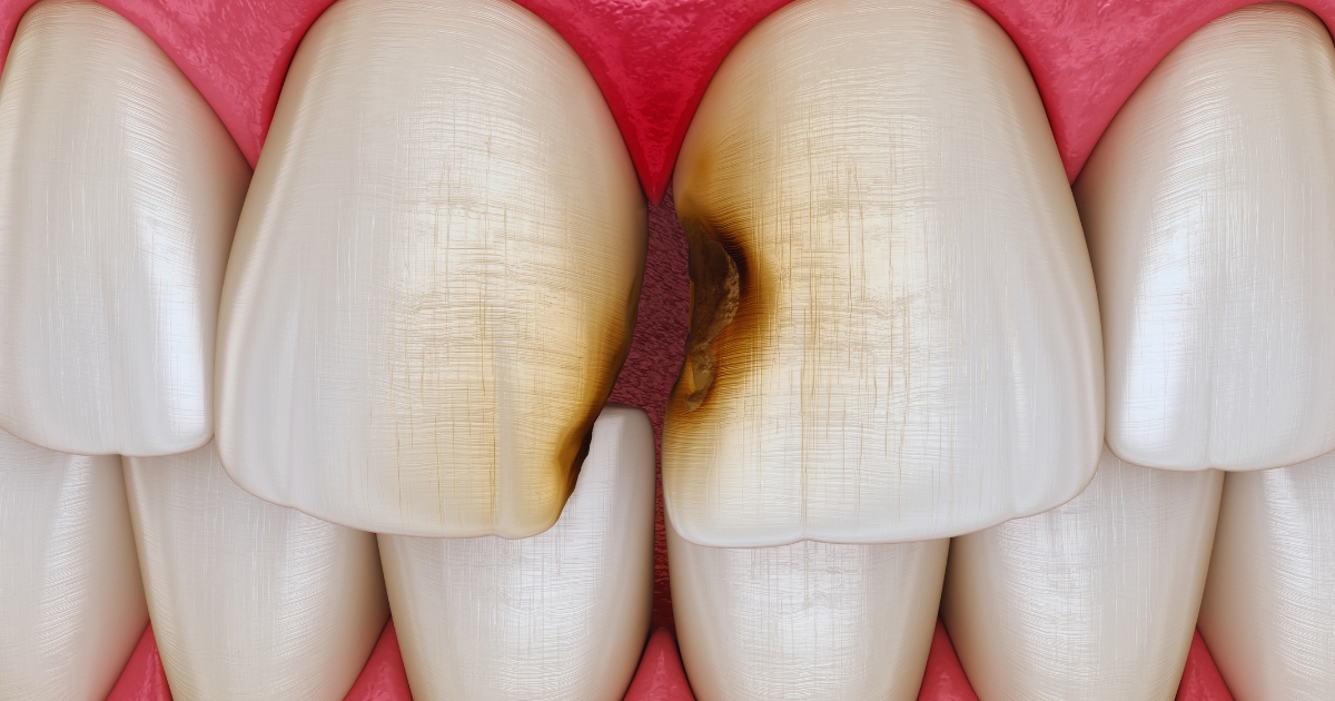 what will an endodontist do for an abscessed tooth