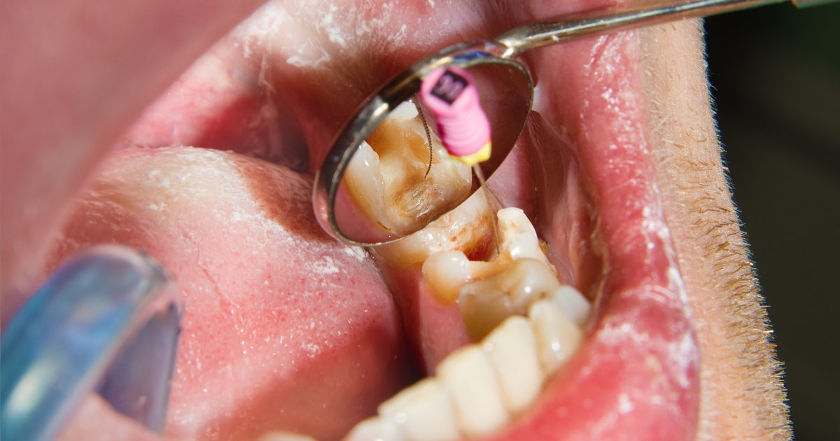 everything about endodontic surgery
