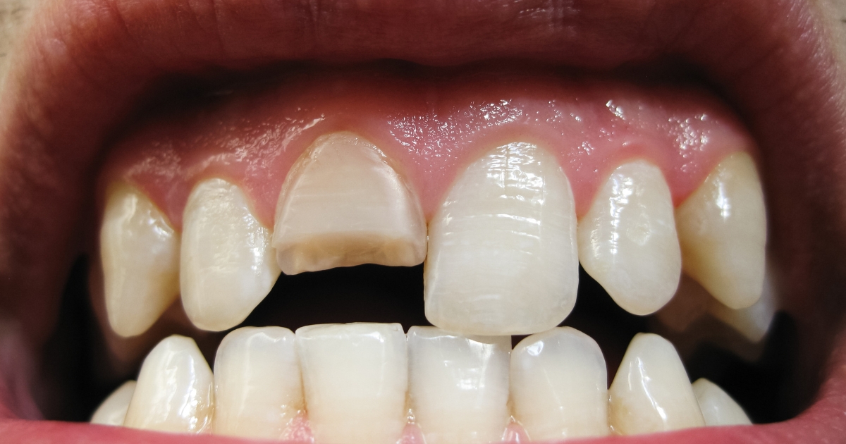 some habits that can result in a cracked tooth