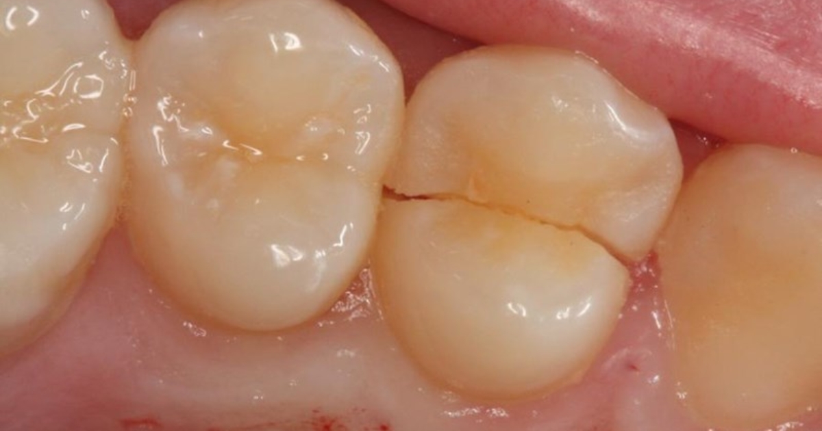 understanding the causes and symptoms of cracked teeth