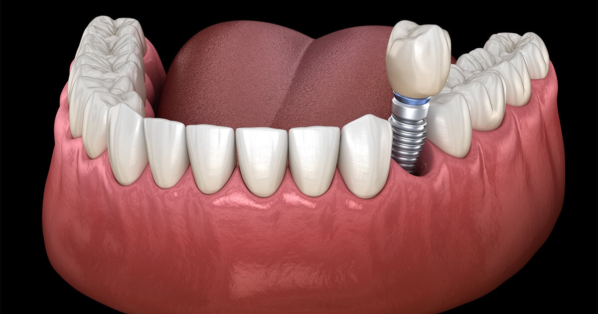 how long do various dental implants last