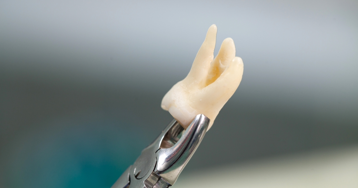 learn whether you can drink coffee after a tooth extraction