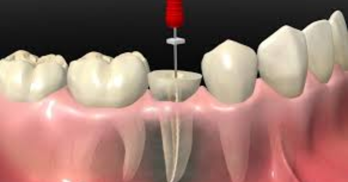 the benefits of early detection for root canal treatment