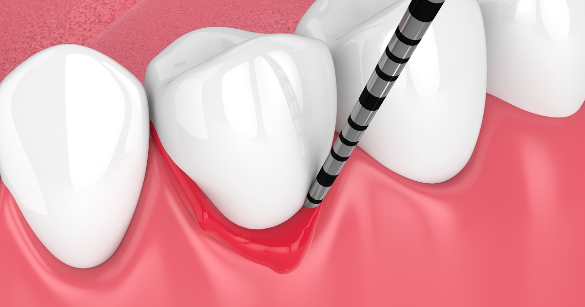 The best way to prevent peri-implant disease