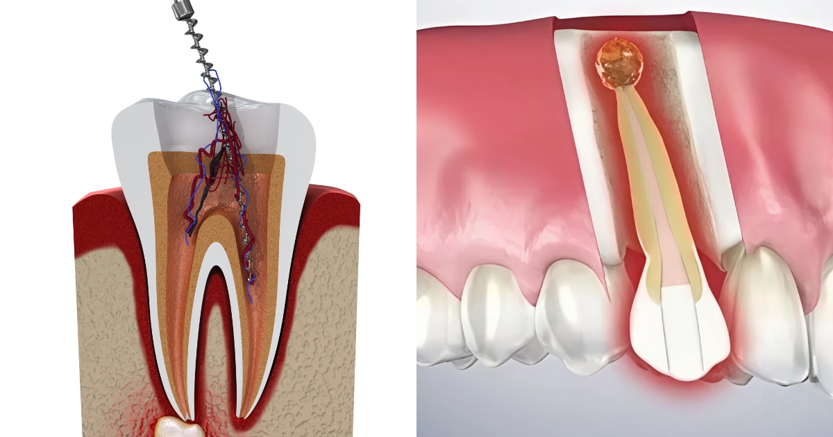 the difference between an apicoectomy and a root canal