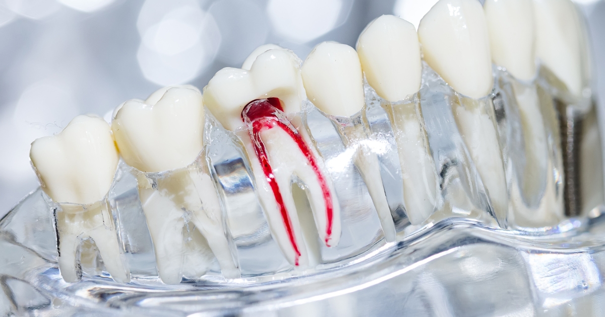 the reasons behind getting a second root canal on the same tooth