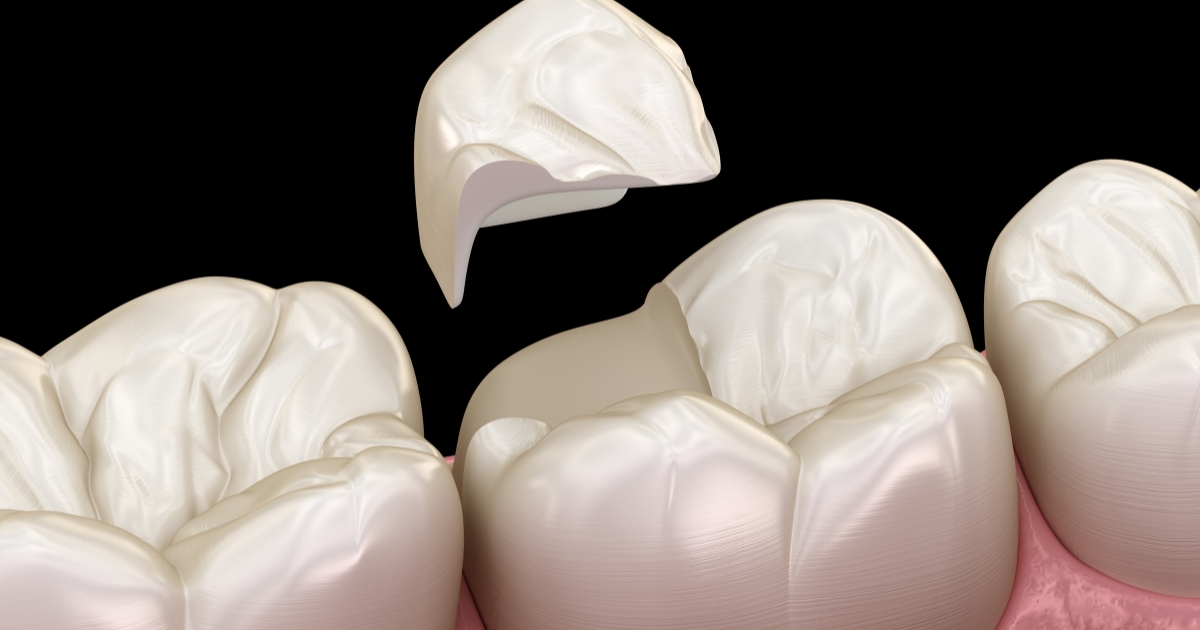 the top 3 ways crown lengthening helps you get a healthier and more beautiful smile