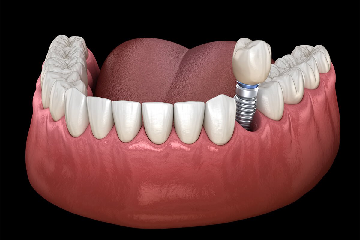 do you need an implant after wisdom tooth removal
