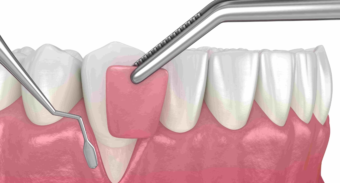 Is Gum Grafting Treatment Painful