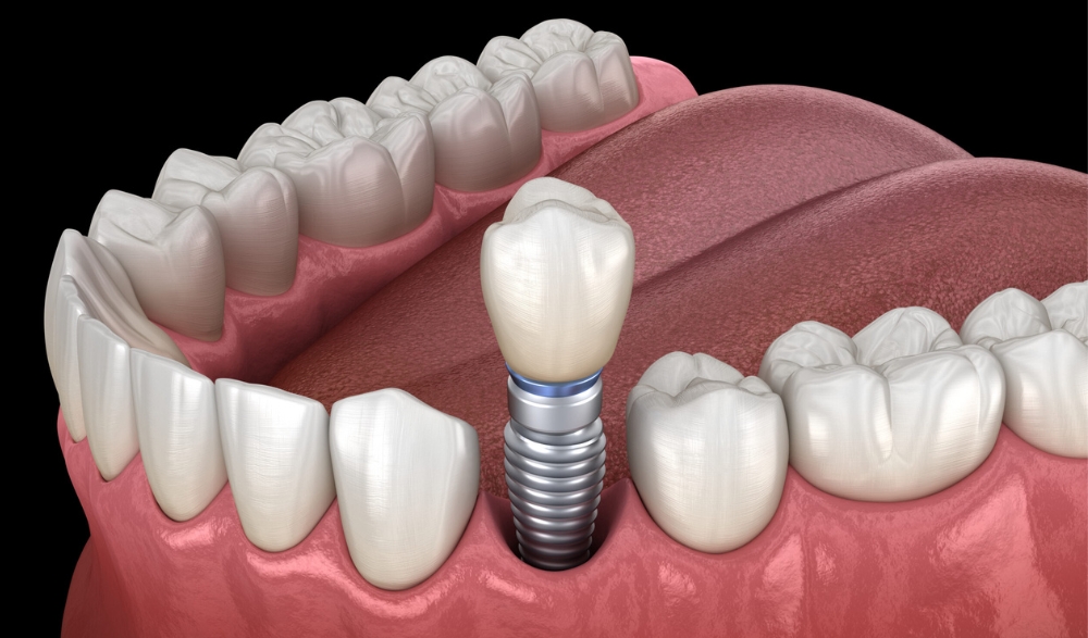 root canal therapy affect the appearance